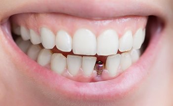 Smile with dental implant post