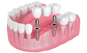 Exploded illustration of dental implant posts, abutments, and restorations