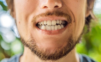 CLose up of person grinding their teeth needing a nightguard for bruxism