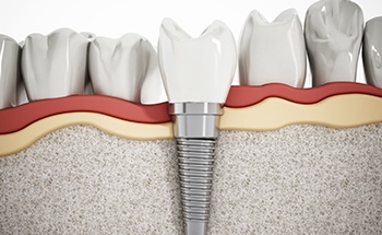 Model of dental implant with dental crown in lower jaw
