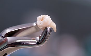 Metal clasp holding an extracted tooth in Woodstock