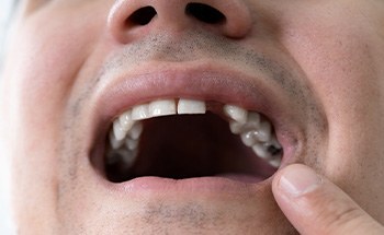 A man suffering from missing teeth