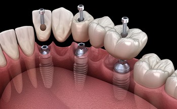 A 3D illustration of an implant bridge being pl