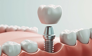 a graphic illustration of an implant crown